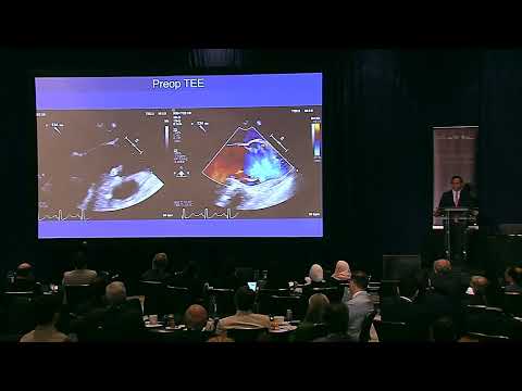 Remodeling of the root for BAV with severe AI and root aneurysm - Ismail El Hamamsy