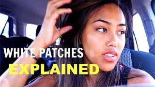 WHITE PATCHES ON SKIN EXPLAINED BY DERMATOLOGIST | TheFrostFamily