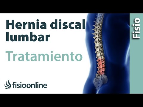 Tratamiento de la hernia discal lumbar mediante automasajes, estiramientos y ejercicios