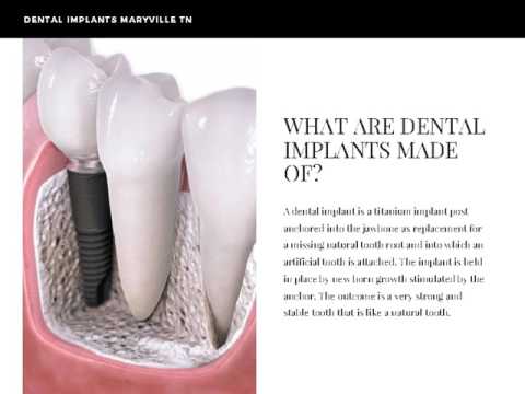 download lagu mp3 mp4 Dental Implants Maryville Tn, download lagu Dental Implants Maryville Tn gratis, unduh video klip Dental Implants Maryville Tn