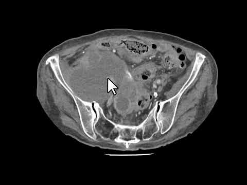 Tumor de ovário irressecável