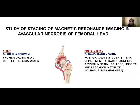 Bandi Babita "STUDY OF STAGING OF MAGNETIC RESONANCE IMAGING INAVASCULAR NECROSIS OF FEMORAL HEAD"