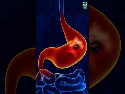 Discover relief and personalized care for Gastritis at Dr. Mhaske Hospital where expertise meets empathy for your digestive well-being.