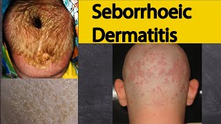 Seborrhoeic dermatitis - Explained under 3 minutes. Seborrheic dermatitis Symptoms and treatment