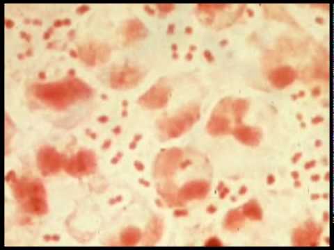 Ritenzione urinaria dopo la biopsia della prostata La necessità di un massaggiatore della prostata