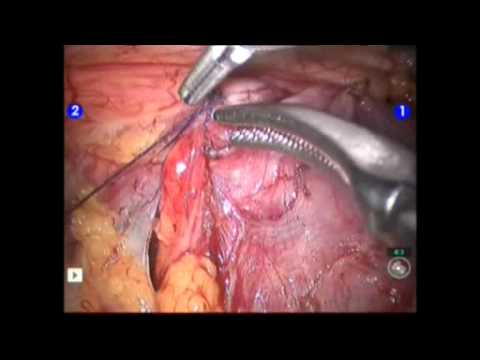 Retroperitoneal And Transperitoneal Pyeloplasty - Robot Assistance