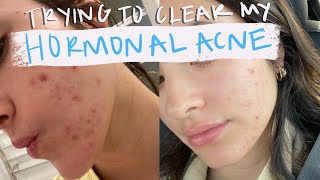 Clearing my Adult Hormonal Acne... after the pill