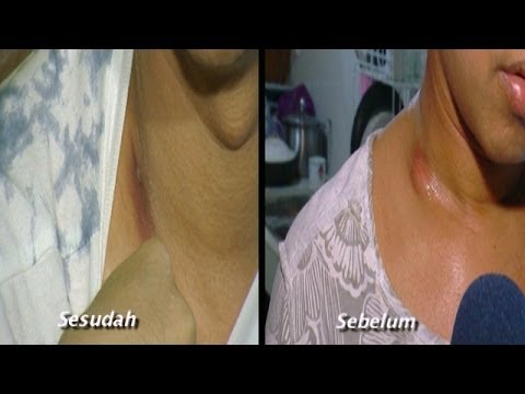 Olga Syahputra Akhirnya Sembuh? - Intens 19 Oktober 2013