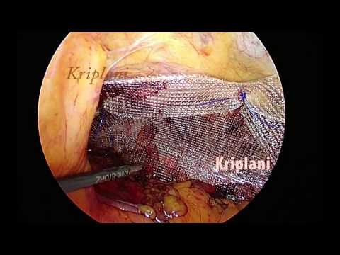 Totally Sutured Laparoscopic TAPP Repair Surgery
