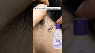 Lice &amp; nits removal Home remedy #liceremoval #licecomb#licetreatment #haircare #liceremoval#piojos