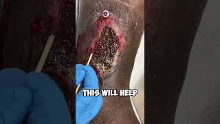 CAUTERIZING A LEG WOUND! 😱 #shorts #woundcare