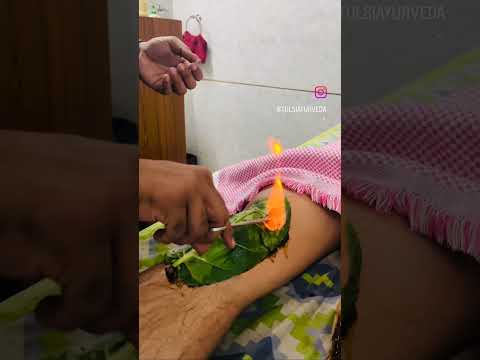 Agnikarma - For pain management | Knee pain