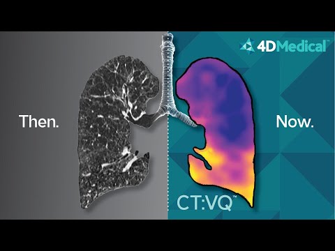 4DMedical (ASX:4DX): Revolutionizing lung health through ...