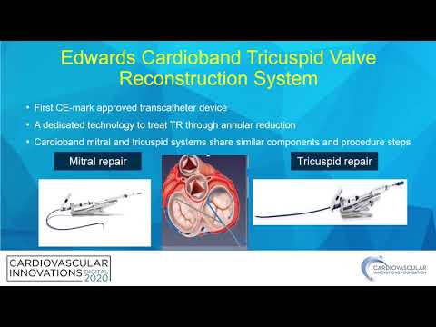 Percutaneous annuloplasty_Szerlip_Structural On Demand
