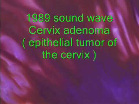 Cervix Adenoma  (epithelial tumor of the cervix) | Binaural Beats | Rife Frequency | 1989 sound wave