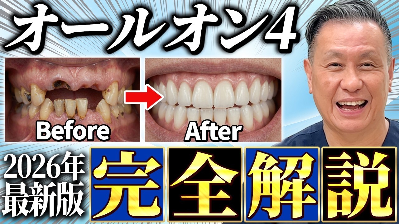 【完全保存版】オールオン4の全てを歯科治療のプロが徹底解説。費用・期間・材質・痛み・ローンまでこれ1本で分かる完全版公開。