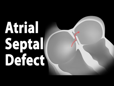 Atrial Septal Defect (ASD), Animation.