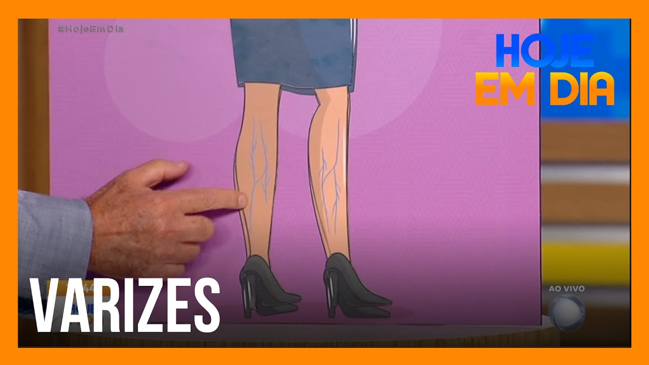 Você e o Doutor: Tire suas dúvidas sobre varizes