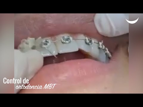 Control de ortodoncia MBT