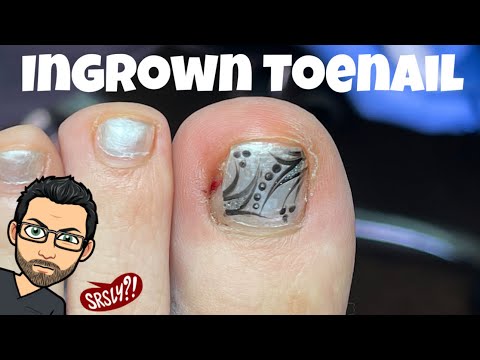 HOW TO REMOVE AN INGROWN TOENAIL IN 3 STEPS (BY A PROFESSIONAL)