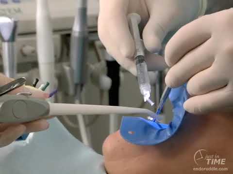 Endodontic Disinfection: Power of the Hand-Held Syringe: Advanced Endodontics: Dr. Cliff Ruddle