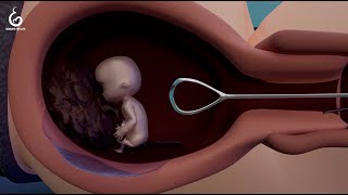 Die Ausschabung – Abtreibungsmethoden