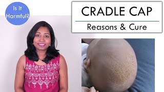 How to get rid of Cradle Cap in Babies? Is it contagious?