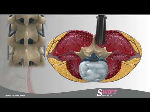 Reno Spine Neurosurgeons Perform the Minimally Invasive Bilateral Laminotomy