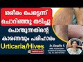 Urticaria Treatment Hives Allergy