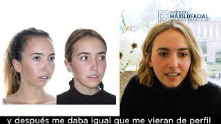 Cirugía ortognática bimaxilar. Caso # 77: Inés - Clase 2, Mordida abierta, hipoplasia mandibular
