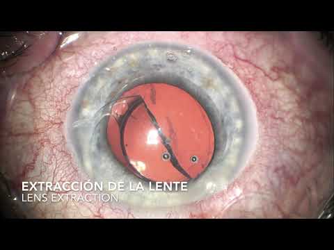 RECAMBIO DE LENTE LENS EXCHANGE