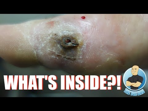 EXTREME FOOT INJURY UNBELIEVABLE REMOVAL!!! WHAT’S STUCK IN THIS FOOT??? FOOT HEALTH MONTH 2018 #15