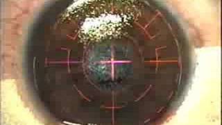 Διόρθωση μυωπίας με την μέθοδο lasik