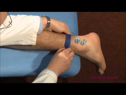 Sensory Neurography - Sural Nerve