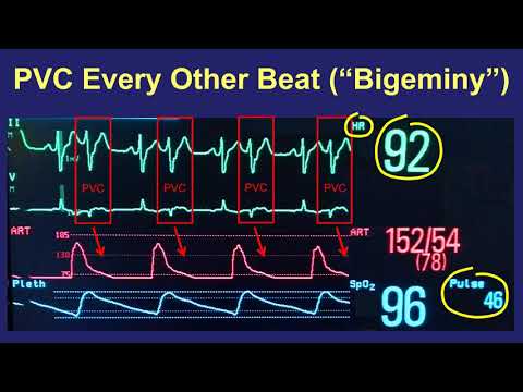 Patient education video titled: PVCs: Symptoms and Treatment - in Plain English