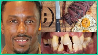 He Ate Steak For The First Time In Years After Full Mouth Dental Implants!