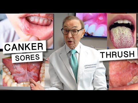 6 Causes of WHITE SPOTS in the Mouth | Home Treatment Options