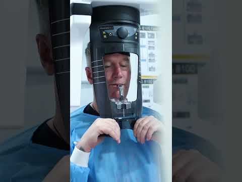 Full Mouth Implants in 15 Days | All-on-6 Procedure for Dental Tourism | Enamel Dental, Hyderabad , India