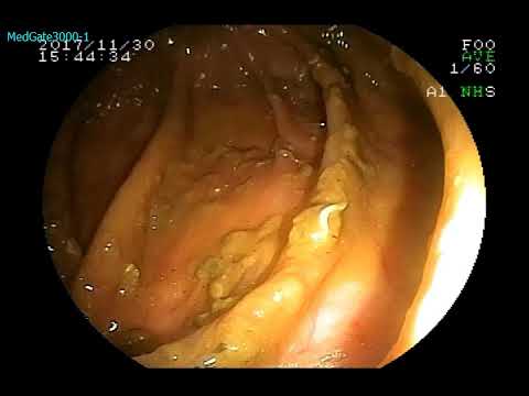 Oxyuriasis Pinworm baby mi a tünetek