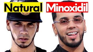Is Anuel AA's Beard Natural or From Minoxidil