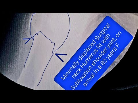Surgical neck Humerus fracture| Subluxation shoulder | Closed reduction | POP U-slab | Adamya Hsp vd