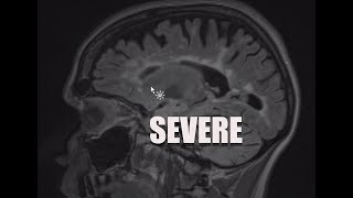 Download lagu Understand Your Scan: MS MRI and Brain Atrophy mp3