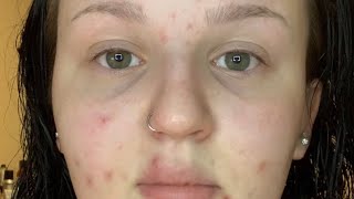 Acne prone skin care routine