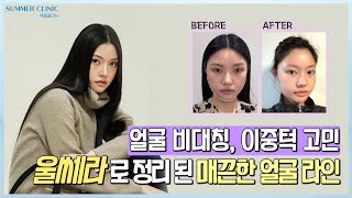 울쎄라로 정리된 매끈한 얼굴라인 | 울쎄라 브이로그