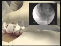 Cervical Spine Radiofrequency Ablation 
