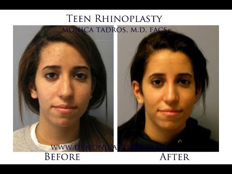 Watch this video from a teenage patient from NJ who had rhinoplasty surgery performed by Dr. Monica Tadros. 

See her amazing results and her experience with a teen nose job surgery.

Before the rhinoplasty surgery, she was having problems breathing and getting congested. The teenage patient noticed a huge improvement in her breathing after a rhinoplasty procedure. 

She is happy with the way she looks and feels more confident. Rhinoplasty procedure performed by Board Certified New Jersey plastic surgeon Dr. Monica Tadros improved her self-esteem.

Teen rhinoplasty has grown increasingly popular among both girls and boys, especially when modern techniques are employed.  Improvement in nasal shape, facial harmony, self-confidence, breathing, and treatment of nasal fractures are among the many reasons. Double Board Certified surgeon Dr. Monica Tadros specializes in teen rhinoplasty for her patients in NJ and Bergen County.

Request your no-obligation teen rhinoplasty consultation in NJ with Dr. Monica Tadros today. You may also call our office to speak to one of our Patient Advisors at (201) 408-5430. Learn more by visiting: https://drmonicatadros.com/our-procedures/teen-rhinoplasty/

Dr. Tadros accepts most POS and PPO insurances for any medical issues related to the ear, nose and throat as an out of network provider.
