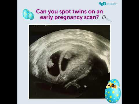 Can you spot twins on an early pregnancy scan? #obgynultrasound #quizchallenge #springoffer