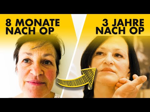 So sieht ihr Fächer-Facelift 8 Monate & 3 Jahre nach OP aus! Dr. Jungwirth