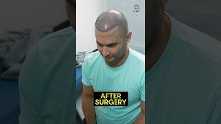Amazing Hair Transplant Journey | Latest Fue Technique #shorts #viral 