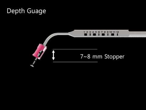 Animation viedo crestal approach with MFS Kit
